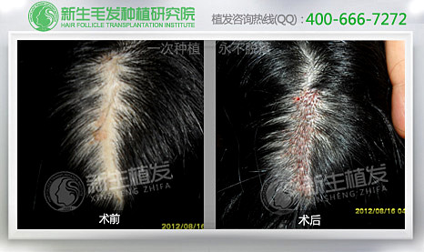 如何担保植发的放心性？