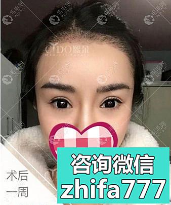眉毛种植后能维持几年？她在北京熙朵植眉1年效果还挺好的