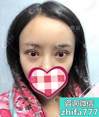 眉毛种植后能维持几年？她在北京熙朵植眉1年效果还挺好的