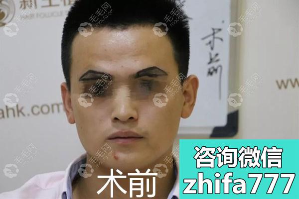 这是一位男士种植眉毛的亲身经历和眉毛种植前后图片对比！