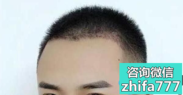 在深圳艺星做了眉毛种植 发际线种植之后，我帅出了新高度