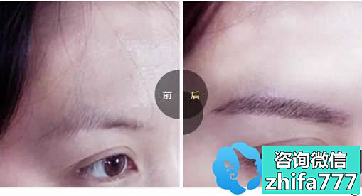 今日分享！桂林华美男性植发案例及种植眉毛一年后的效果图