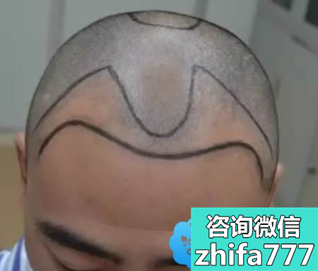 今日分享！桂林华美男性植发案例及种植眉毛一年后的效果图