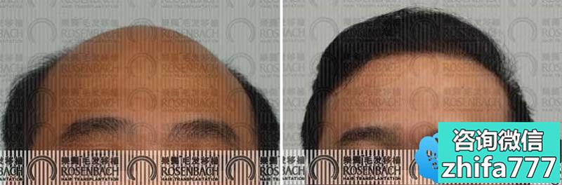 广州乐鬓植发案例 植发手术治疗秃顶