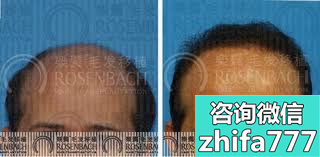 广州乐鬓植发案例 男性秃顶植发手术效果