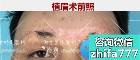男士植眉案例：广州南方医院苗勇种植眉毛一年后效果图赏析