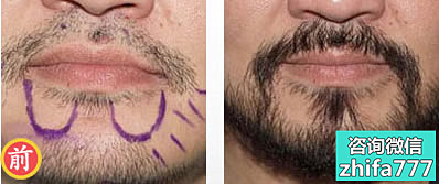 烟台华怡种植胡须真实案例 胡须男人的魅力与象征