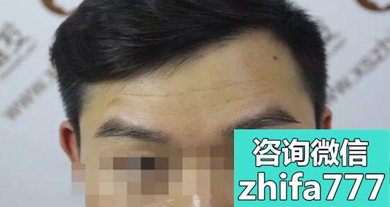 眉毛种植术后1年效果图来证明郑州新生植发怎么样