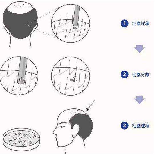 鬓角植发的技术有哪些呢？