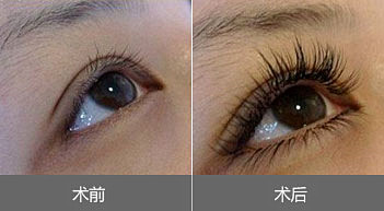 南京睫毛种植放心么？对视力有影响么？
