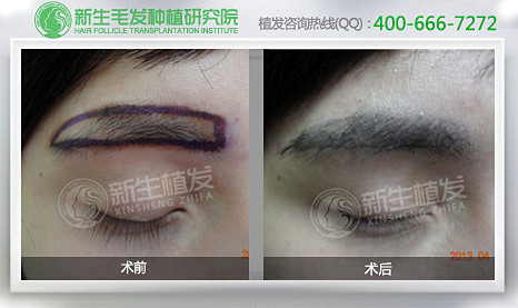 南京眉毛种植可以解决哪几种眉形缺陷
