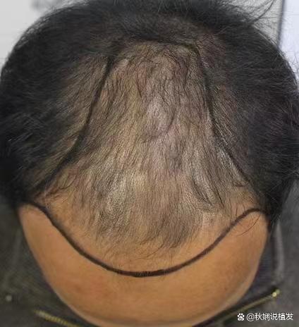 花大几万到北京做植发，术后1年先生说：后悔了？
