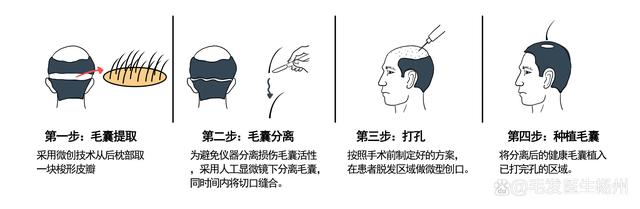 什么情况需要植发？七级以上脱发还有必要植发吗？