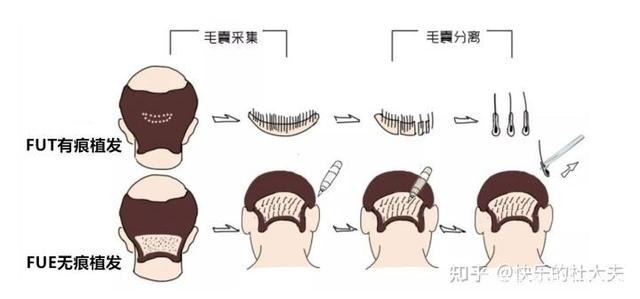 FUT、FUE、宝石刀种植和微针植发技术，有什么区别？