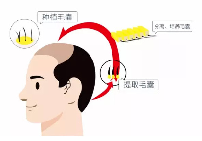 植发治疗脱发的优势到底在哪？