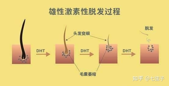 这几类人千万别植发！植发失败的问题该如何避免