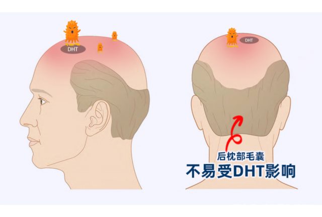 一台好的植发手术标准需要从多方面进行考量