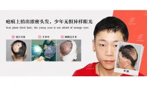烧伤烫伤的疤痕植发 国际性难题 徐霞博士怎样攻破的？