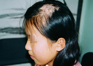 烧伤烫伤的疤痕植发 国际性难题 徐霞博士怎样攻破的？