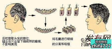 植发手术，让你的美不再有缺憾！ 心动就行动起来吧