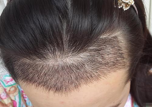 女性植发适合吗？女性植发有副作用吗？