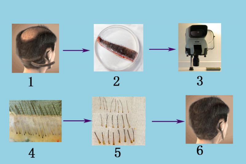 植发有风险吗？关于植发失败问题总结会不会留下后遗症