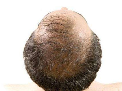 男性脱发有哪些危害呢？