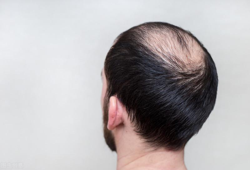 如何治头发稀少 五个简单的生发方法