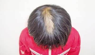 遗传性脱发是否可以预防呢？