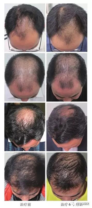 米诺地尔治疗脱发有效果吗？