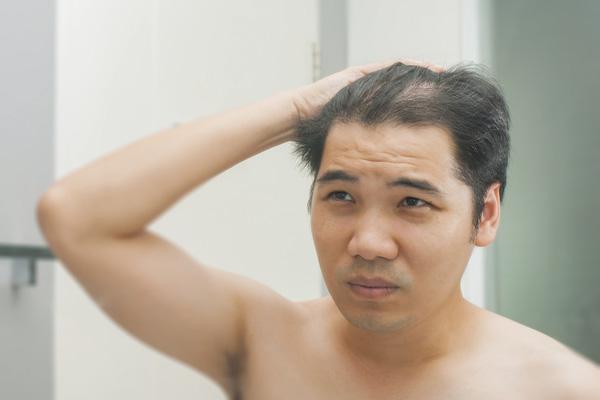 男人脱发的最重要原因是什么