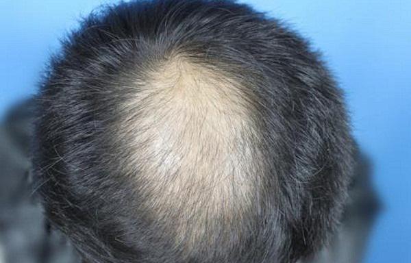 骨质疏松药物可以治疗脱发吗