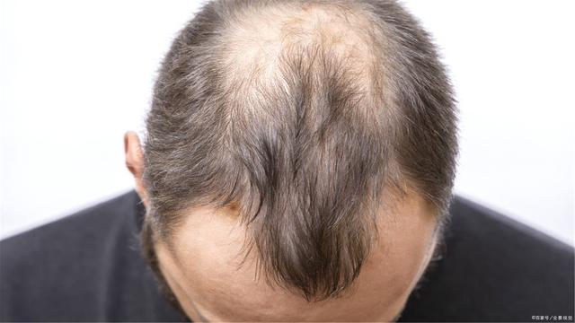 怎样可以生发？治疗脱发最有效的方法