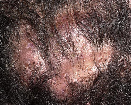 如何治疗毛囊炎，需要避免什么？
