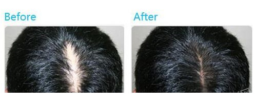 头发稀疏加密种植手术要多久？头发稀疏加密种植会失败吗？