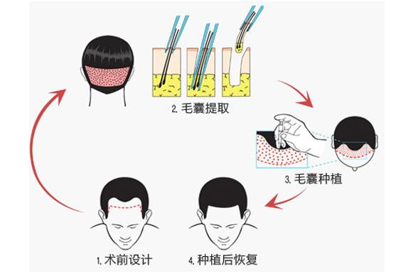 应该如何解决男性脱发的问题呢？