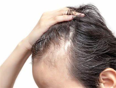 甲状腺会影响男性脱发吗