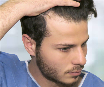 使用哪种治疗方法治疗脱发最有效
