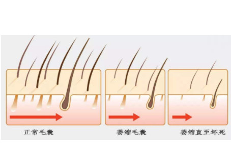 为什么毛囊会萎缩，是什么原因？