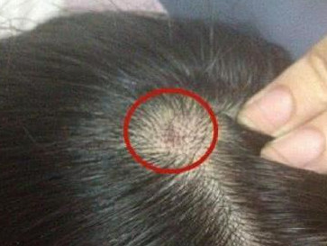 为什么头皮上会有痘痘，要怎么预防呢？