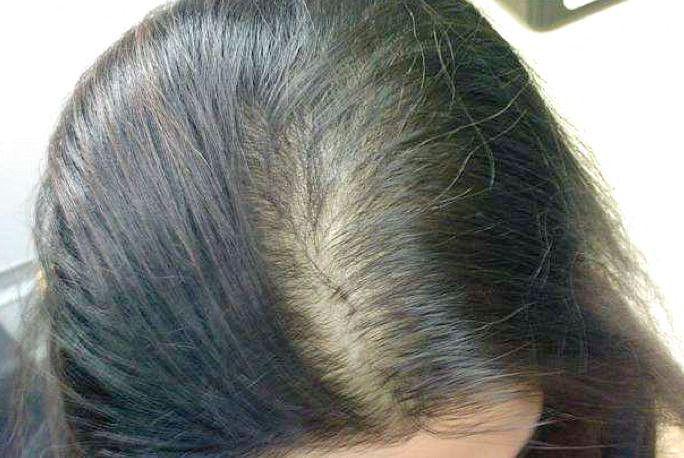 女性脱发怎么办？教你几招挽救你的头发！