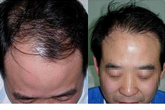 杭州植发医院头发种植有保护吗
