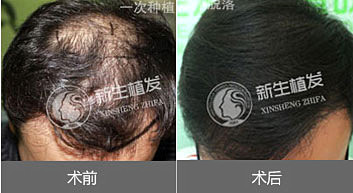头发种植后该如何护理头发