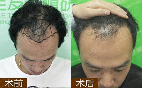 在杭州新生医疗头发保养的生活常识？