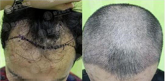新生植发专家告诉发友治疗脱发有多重要