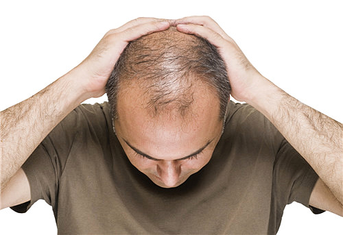 雄激素脱发怎么治？