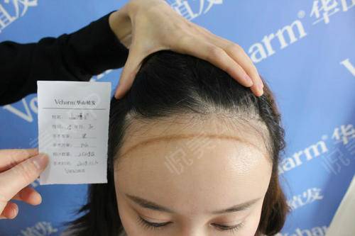 郑州华山植发发际线头发在持续长长中秀发更出众