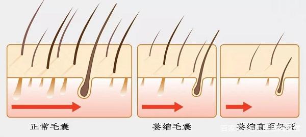 脱发后能否恢复正常，还是会永无止境地脱下去？