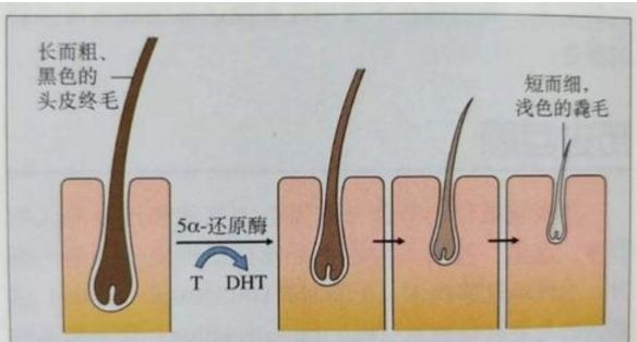 阻断DHT救回头发，DHT脱发这6种食物同样可以做到！