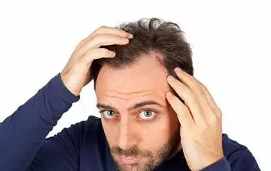 男性型脱发的早期表现症状，吸烟与脱发的关系？